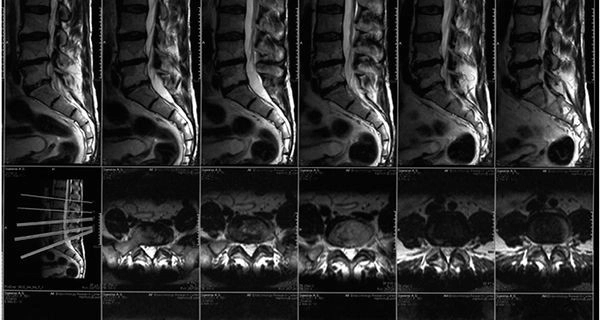 МРТ Позвоночника и сочленений