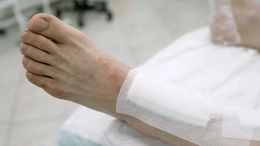 Надо ли удалять винты после операции Hallux valgus?