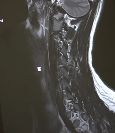Для чего нужно МРТ шейного отдела позвоночника