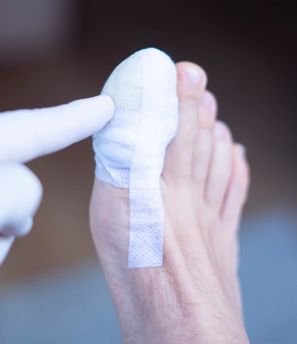 Надо ли удалять винты после операции Hallux valgus?