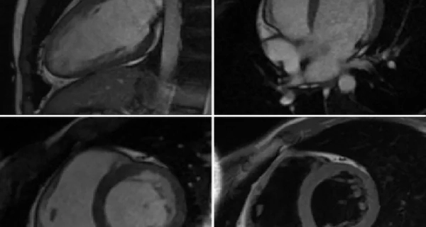 МРТ Сердца и сосудов